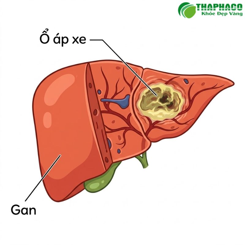 Nguyên Nhân Và Yếu Tố Nguy Cơ Gây Áp Xe Gan