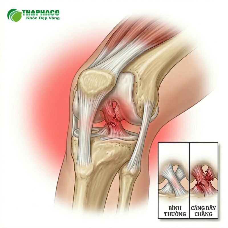 căng dây chằng là gì