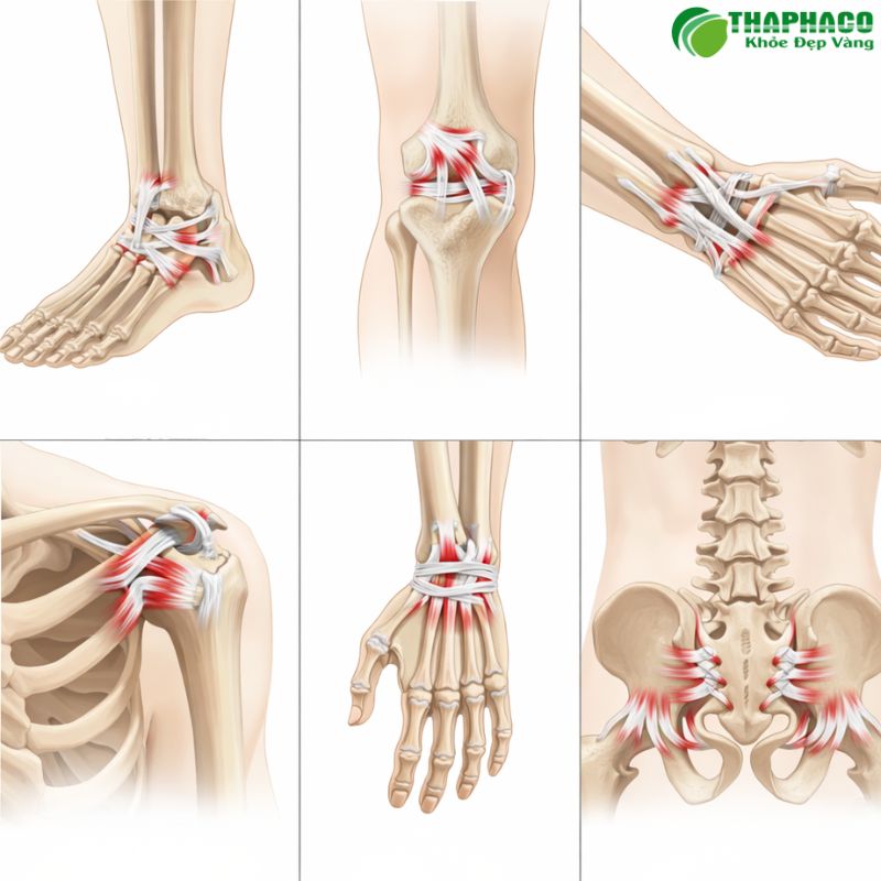 Căng dây chằng có thể xảy ra ở mắt cá chân, đầu gối, cổ tay, vai và lưng