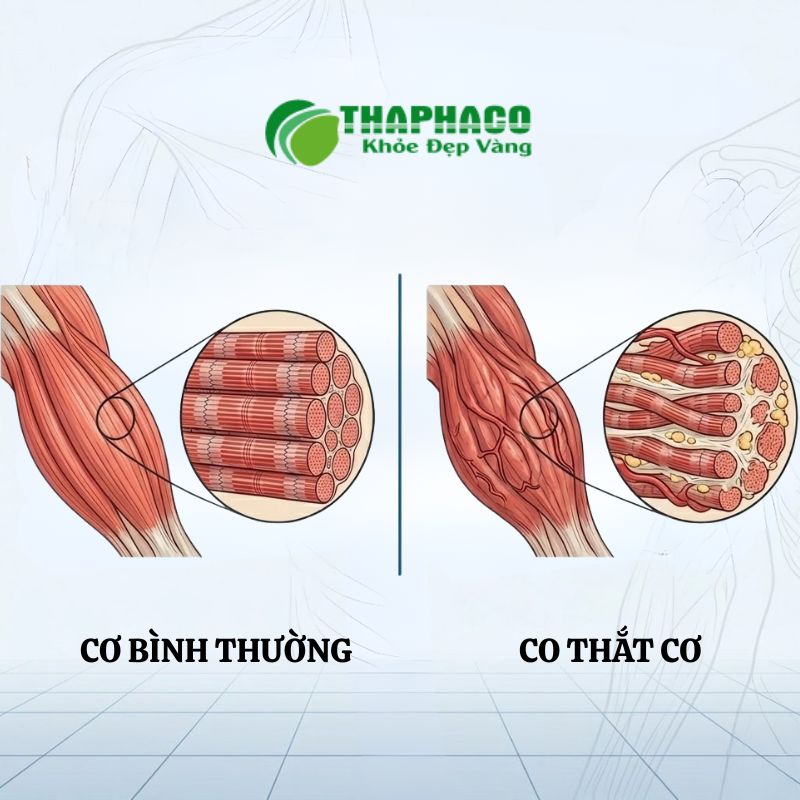 Co thắt cơ là sự co rút đột ngột, không tự chủ của một hoặc nhóm cơ, gây đau nhức và cứng