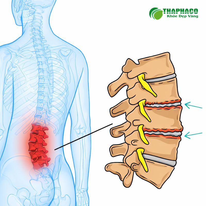 Dấu Hiệu Nhận Biết Và Biến Chứng Nguy Hiểm Của Thoái Hóa Cột Sống Sớm