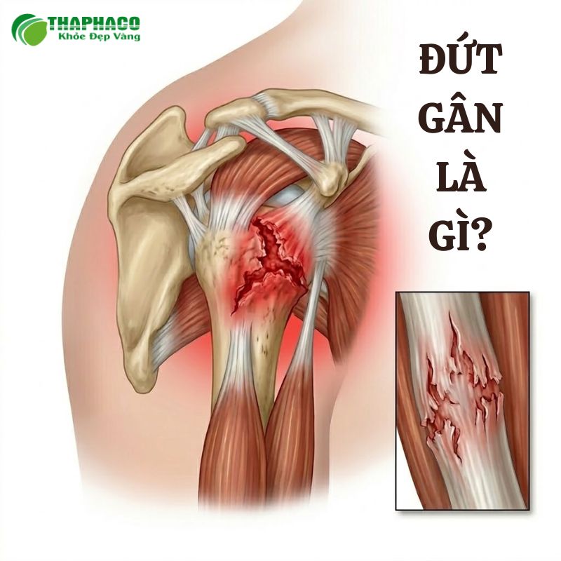 đứt gân là gì