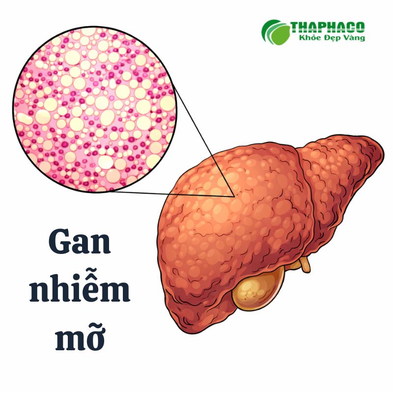 Triệu Chứng Của Gan Nhiễm Mỡ