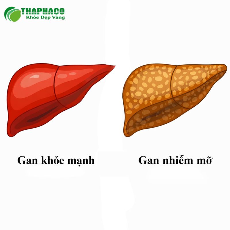 Giải Pháp Phòng Ngừa & Điều Trị Gan Nhiễm Mỡ Hiệu Quả