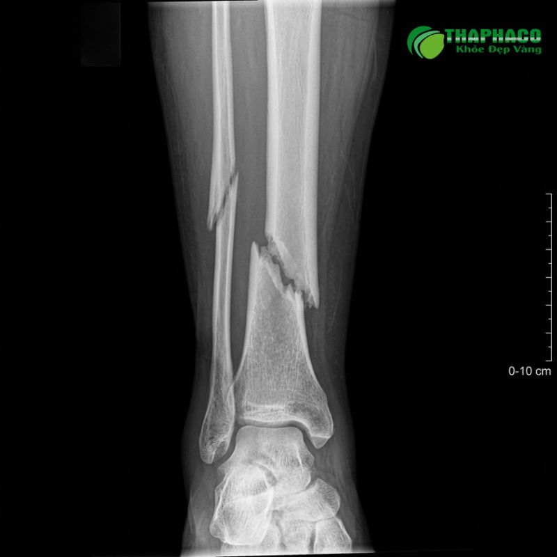 Không điều trị gãy xương kịp thời có thể dẫn đến nhiều biến chứng nguy hiểm