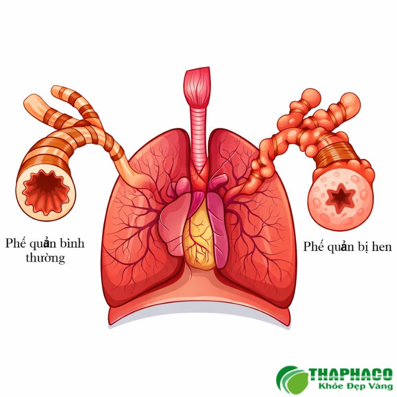 Lưu ý quan trọng khi dùng thảo dược hỗ trợ hen phế quản