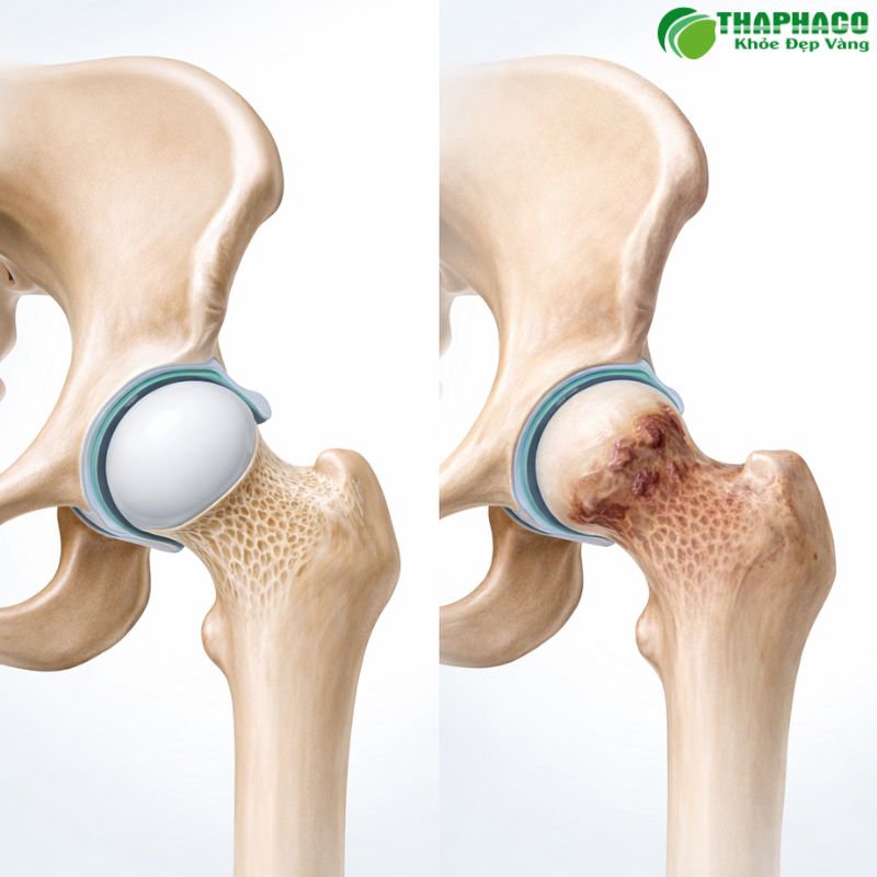 Hoại tử xương là tình trạng tế bào xương bị chết do thiếu máu nuôi dưỡng