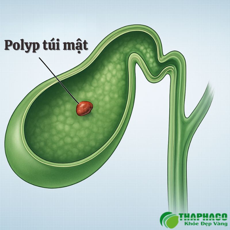 polyp túi mật là gì