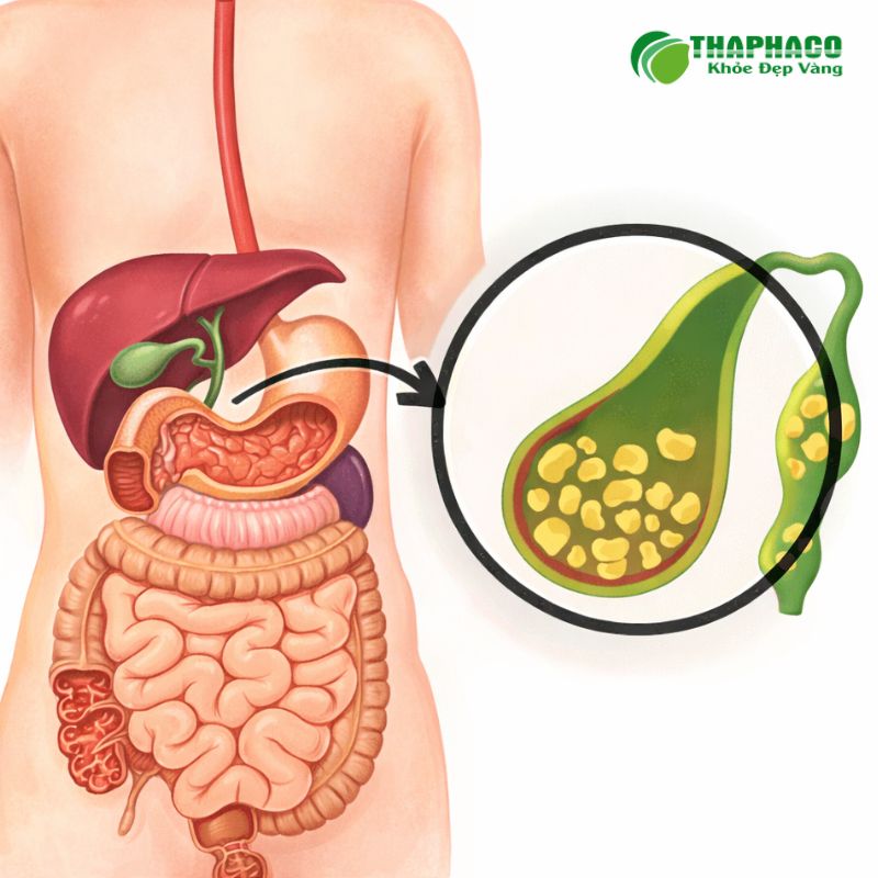 Sỏi mật là sự kết tụ các thành phần trong dịch mật, hình thành viên sỏi trong túi mật hoặc đường mật