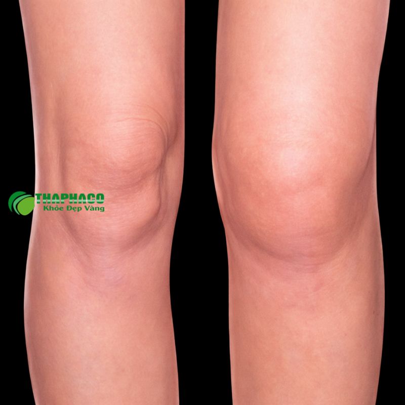 Giải Pháp Hỗ Trợ Giảm Sưng Nóng Đỏ Khớp Từ Dược Liệu Tự Nhiên Thaphaco