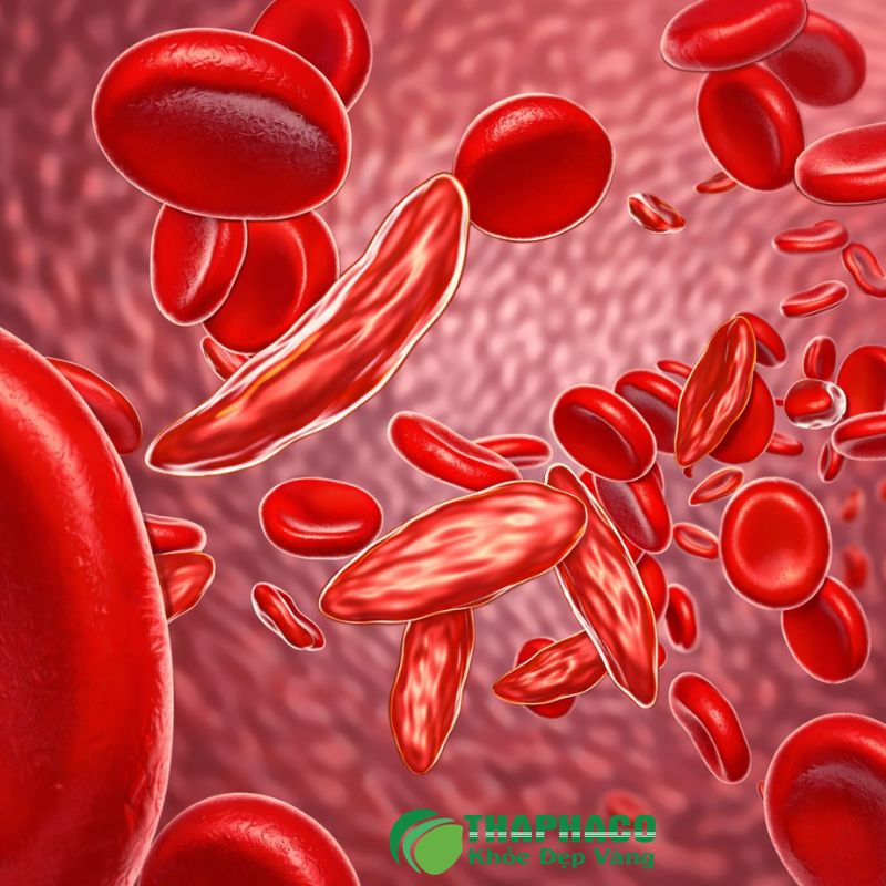 Bệnh Thalassemia gây thiếu máu mãn tính, biểu hiện qua xanh xao, vàng da, chậm phát triển