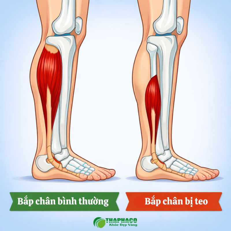 Có hai loại teo cơ chính: teo cơ do không hoạt động và teo cơ do bệnh lý thần kinh