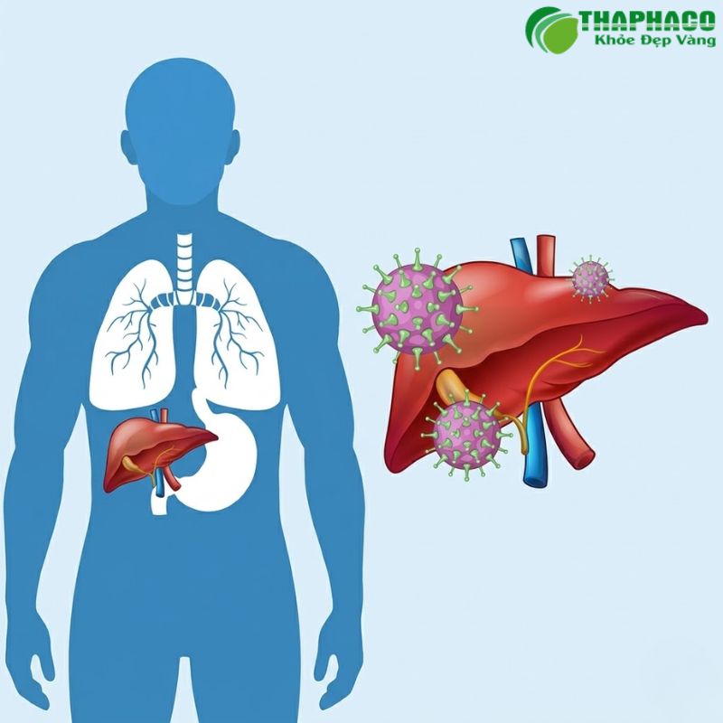 Teo gan dẫn đến nhiều biến chứng nguy hiểm như suy gan, cổ trướng