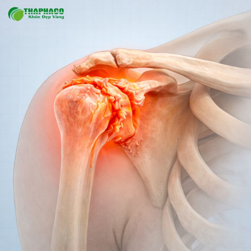 Thoái hóa khớp vai là tình trạng sụn khớp bị tổn thương và bào mòn theo thời gian