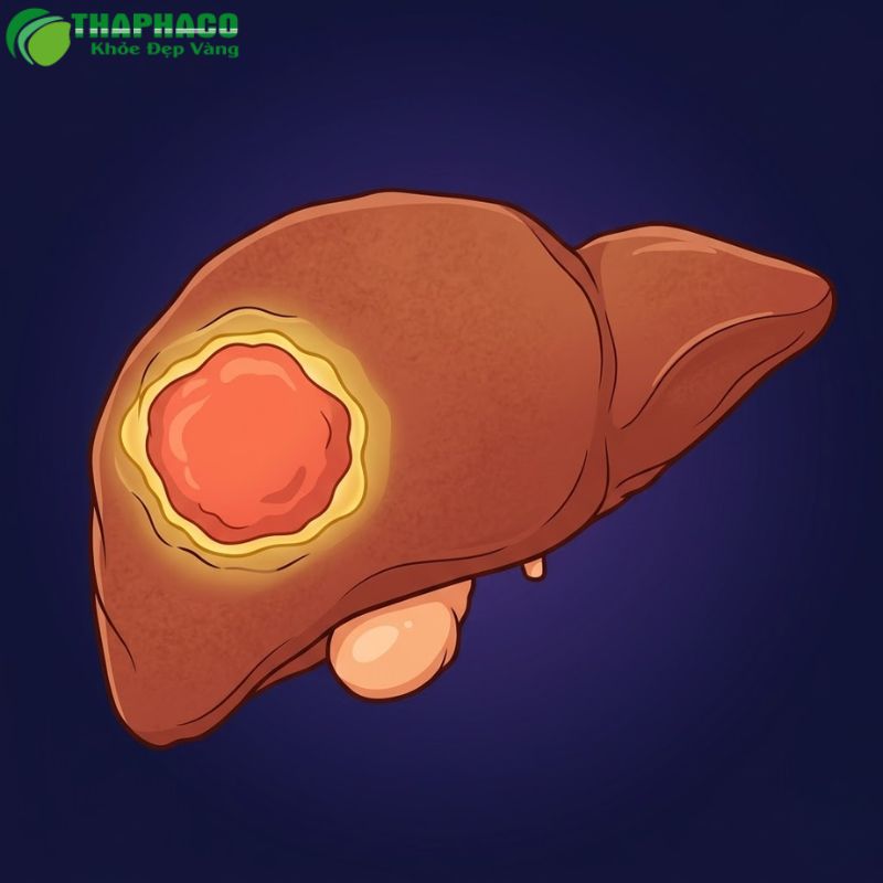 Ung thư gan thường do viêm gan virus B, C mạn tính và xơ gan gây ra