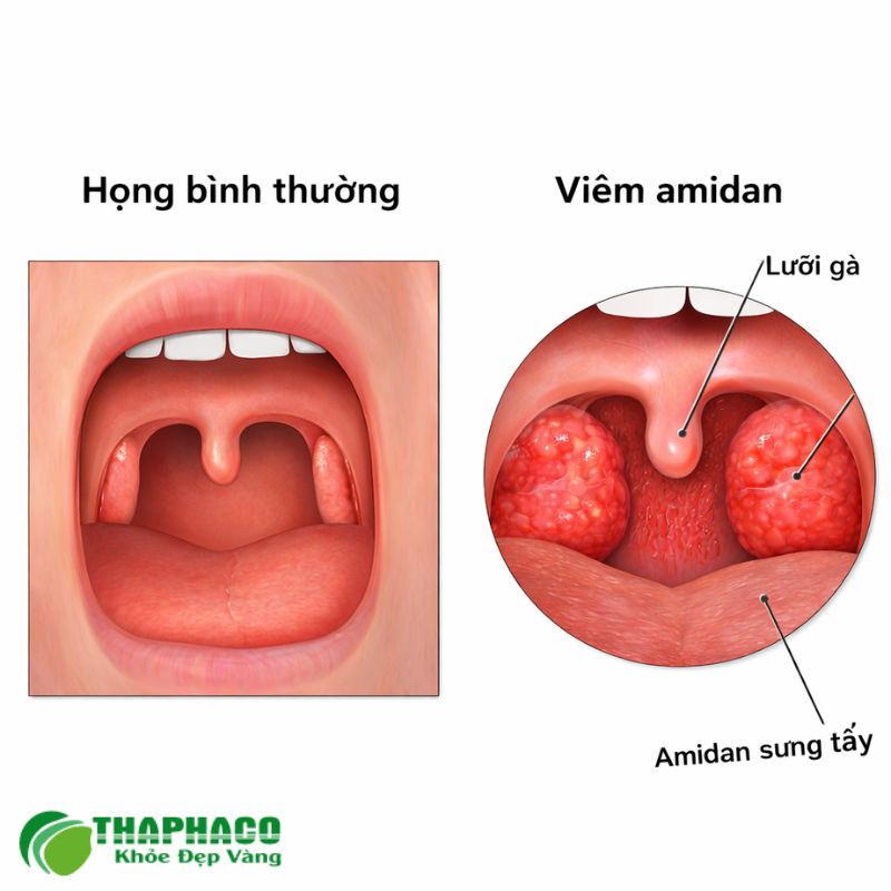 viêm amidan là gì