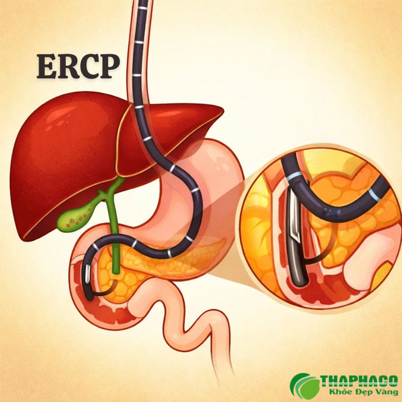 viêm đường mật xơ hoá nguyên phát là gì