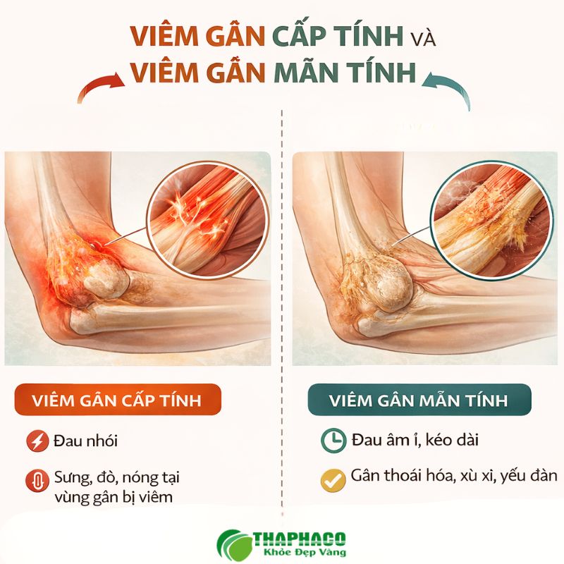 Viêm gân là tình trạng viêm hoặc kích ứng gân, cấu trúc mô sợi dày nối cơ với xương