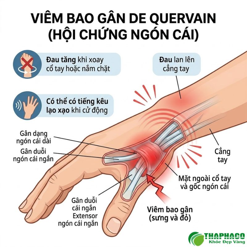 Tình trạng viêm bao gân của hai gân chạy dọc ngón cái