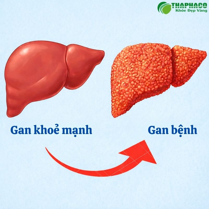 Viêm gan cấp là tình trạng viêm nhiễm đột ngột ở gan, thường kéo dài dưới 6 tháng