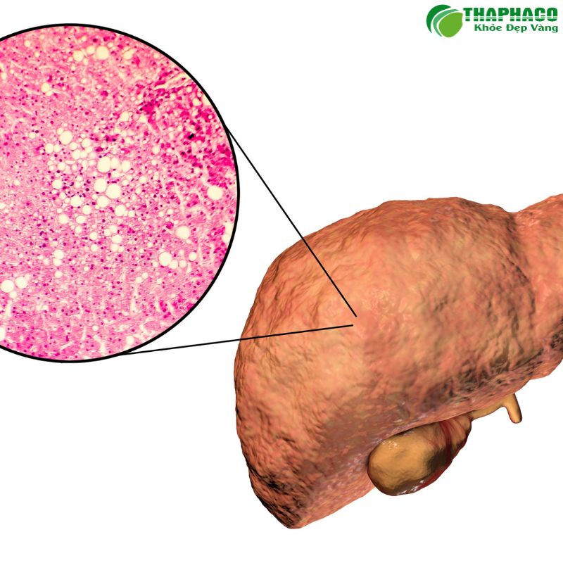 Nếu không được điều trị kịp thời, viêm gan nhiễm độc có thể dẫn đến suy gan cấp
