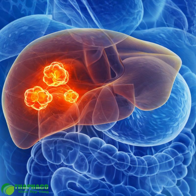 Lưu Ý Quan Trọng Khi Điều Trị và Phòng Ngừa Viêm Gan Do Vi Khuẩn