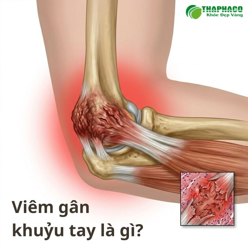 viêm gân khuỷu tay là gì