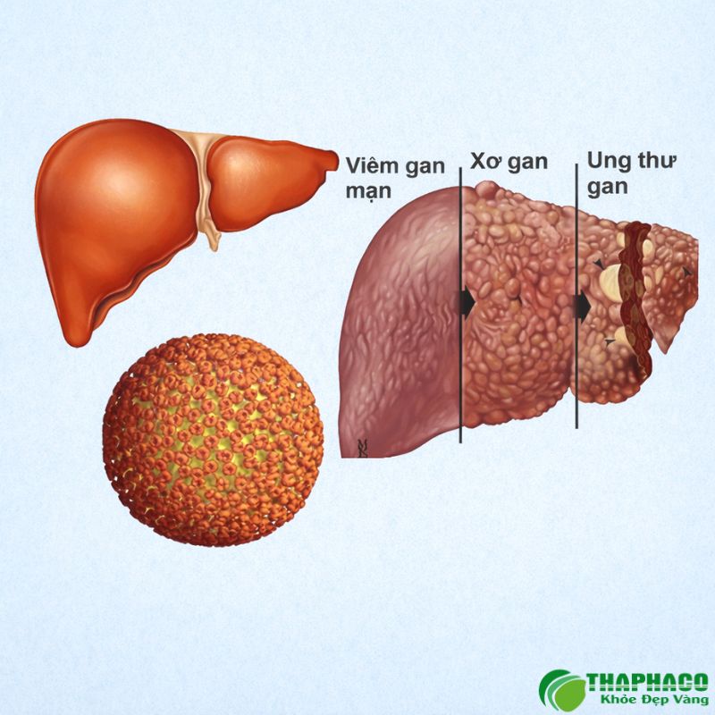 viêm gan mạn là gì