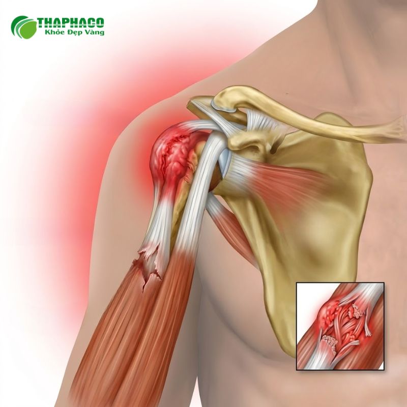 viêm gân vai là gì