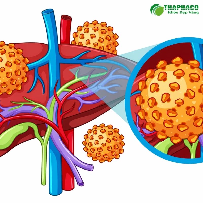 Viêm gan virus B là bệnh nhiễm trùng gan do virus HBV gây ra