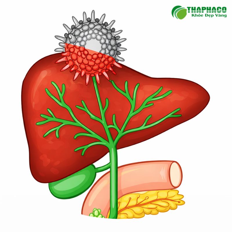 Nguyên nhân, Triệu chứng và Biến chứng nguy hiểm của Viêm gan virus C