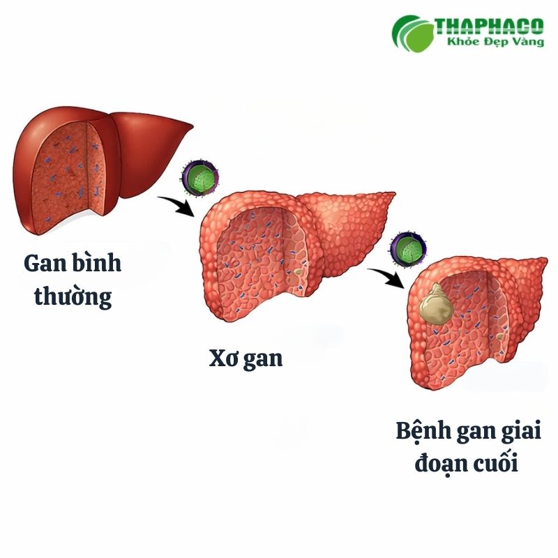 Nếu không được điều trị kịp thời, viêm gan E có thể dẫn đến suy gan cấp
