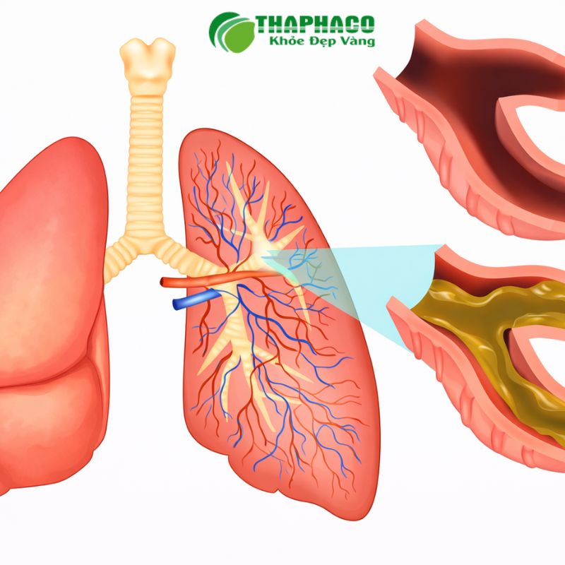Hướng Dẫn Sử Dụng Dược Liệu Thaphaco Hỗ Trợ Viêm Khí Quản Đúng Cách