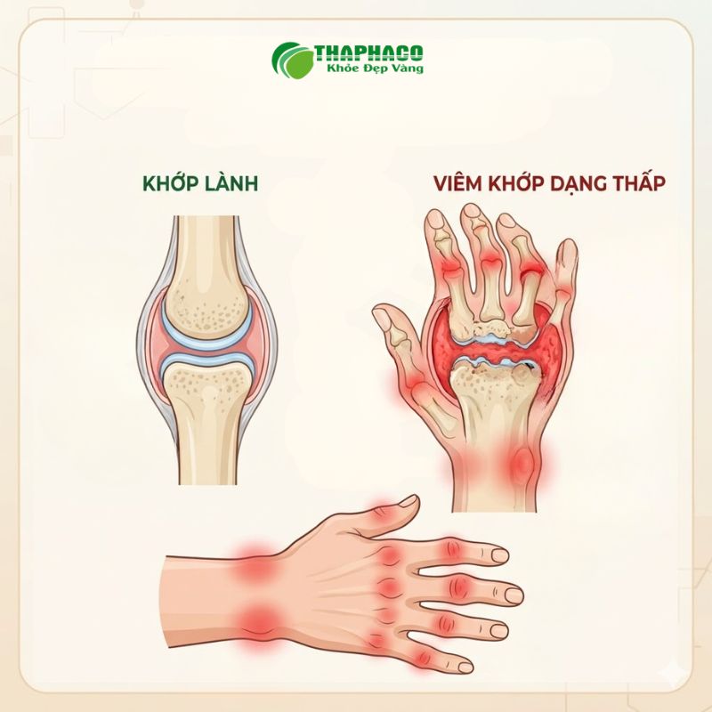 Viêm khớp dạng thấp là một căn bệnh tự miễn mạn tính gây tổn thương khớp