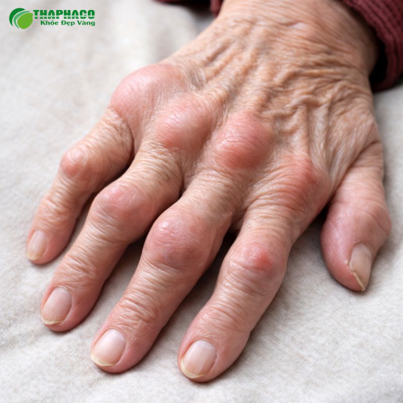 Triệu Chứng Nhận Biết Viêm Khớp Dạng Thấp