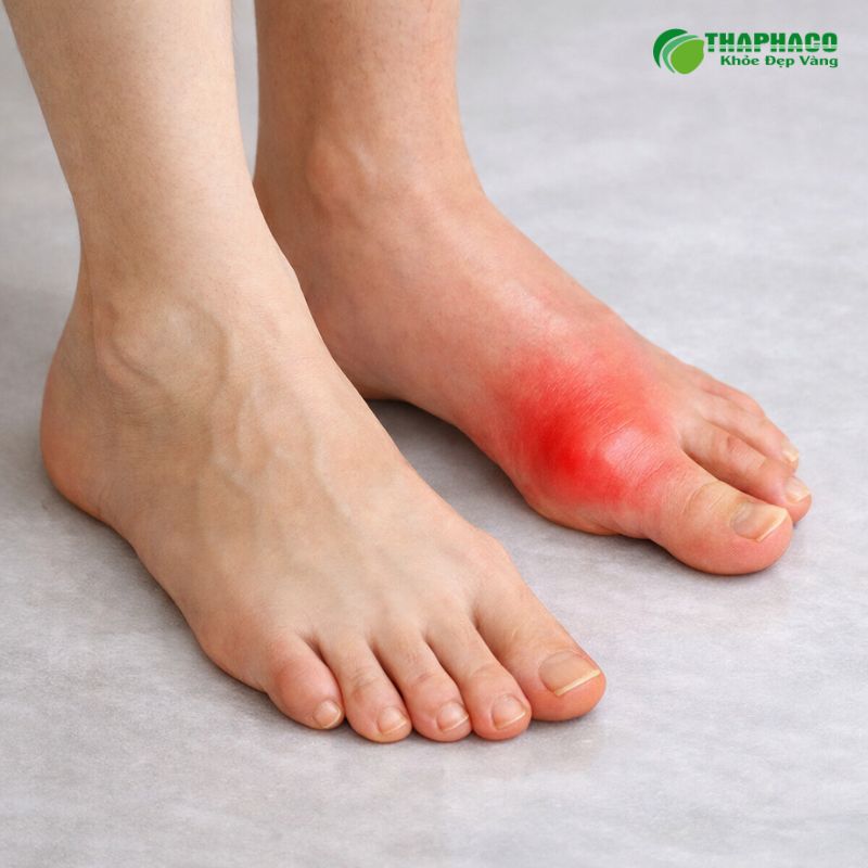 Viêm khớp mạn tính là gì