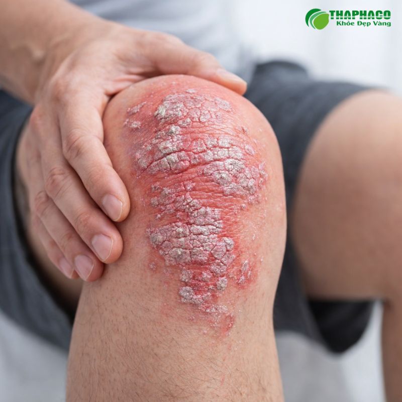 Viêm khớp vảy nến là bệnh viêm khớp mạn tính ở người mắc vảy nến