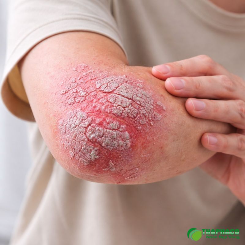 viêm khớp vảy nến là gì