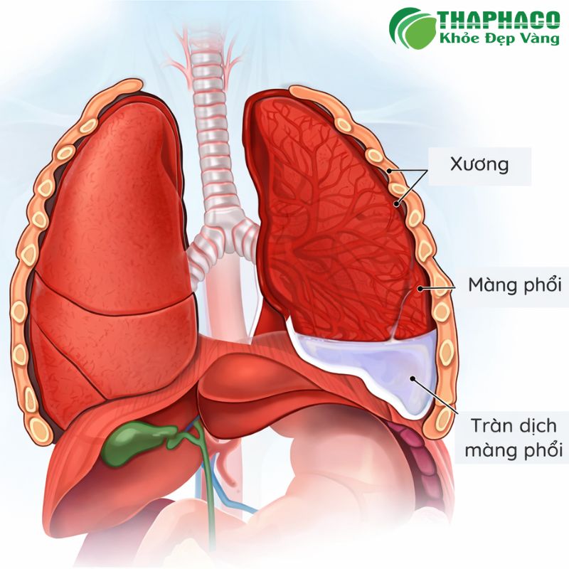Khi tình trạng viêm tiến triển, cơ thể tiết dịch vào khoang màng phổi, dẫn đến viêm màng phổi ướt
