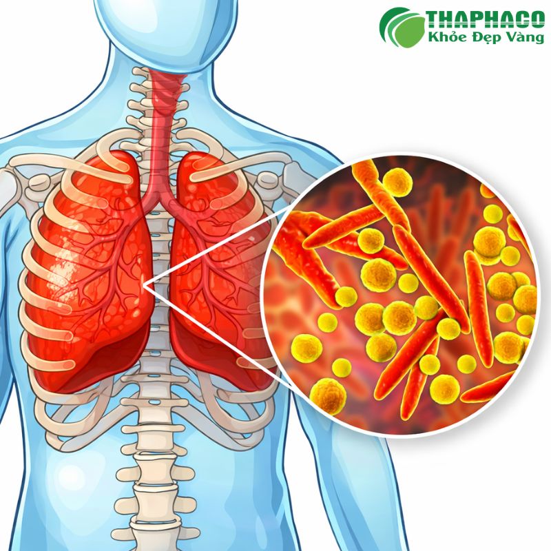 Viêm phổi do ký sinh trùng là tình trạng viêm nhiễm phổi gây ra bởi các loài ký sinh trùng khác nhau