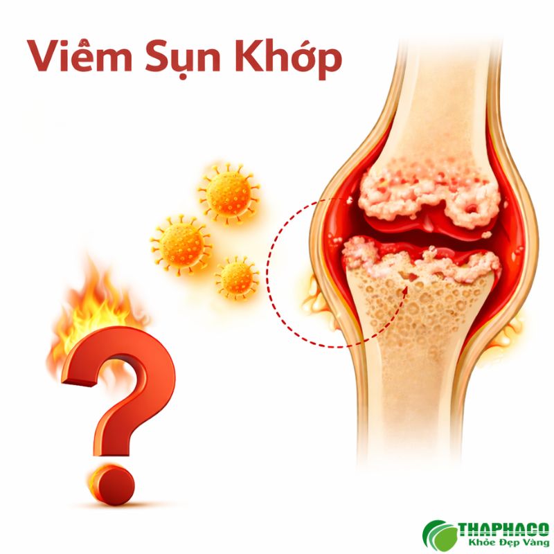 viêm sụn khớp là gì