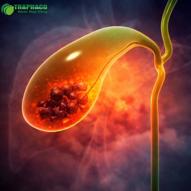 viêm túi mật là gì