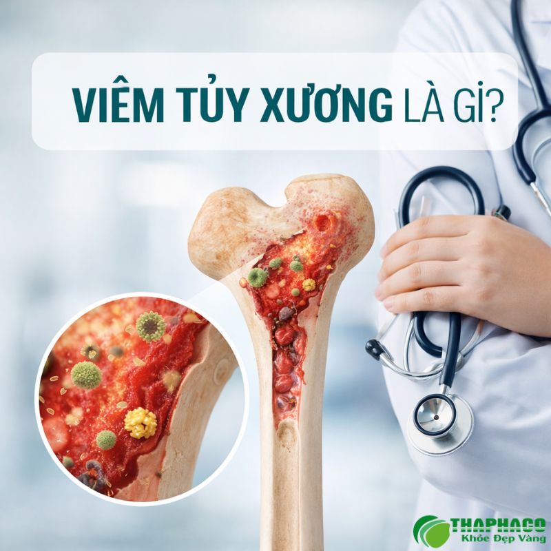 viêm tuỷ xương là gì