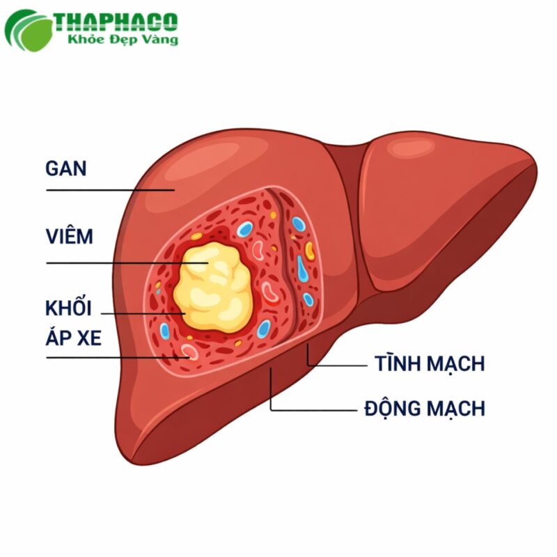 Biến chứng nguy hiểm của áp xe gan amip nếu không điều trị kịp thời