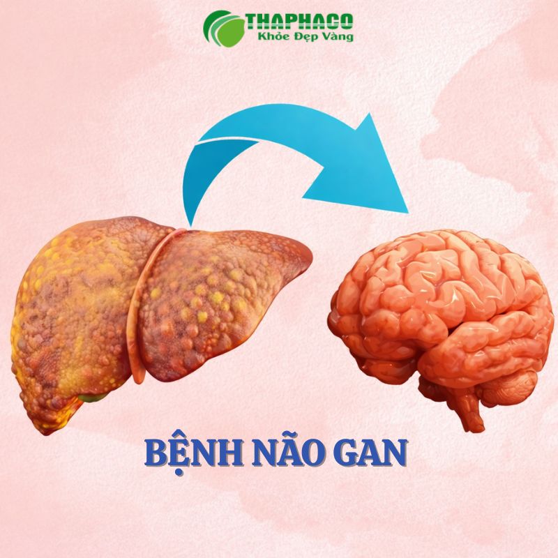 bệnh não gan (hôn mê gan) là gì