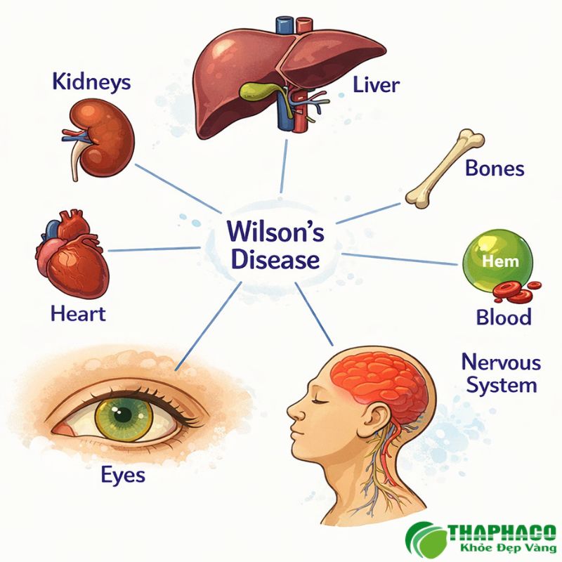 bệnh wilson là gì
