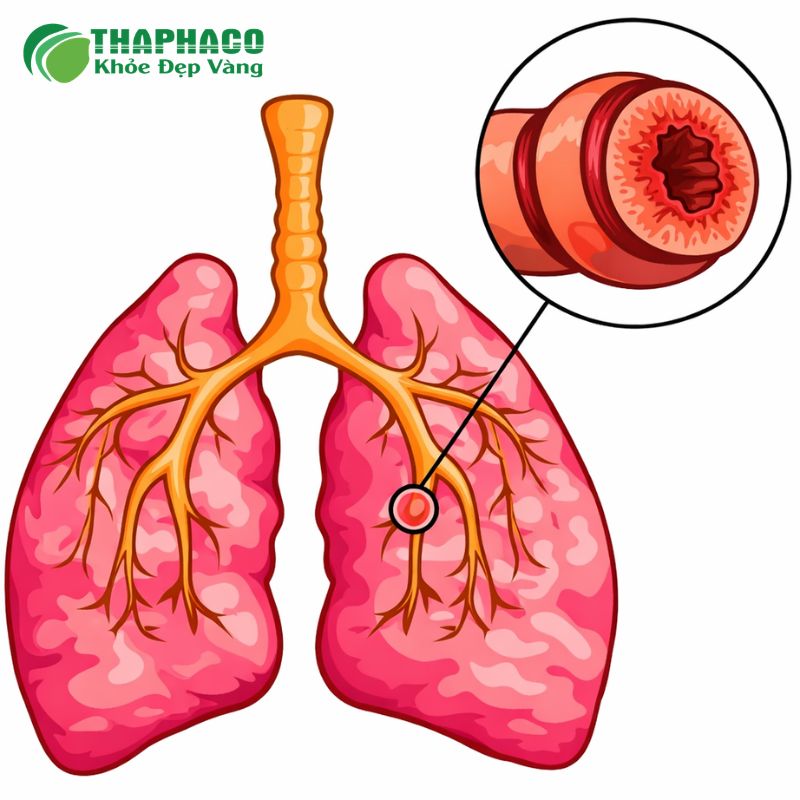 Co thắt phế quản là tình trạng các cơ trơn đường thở bị co thắt, gây hẹp lòng phế quản và khó thở