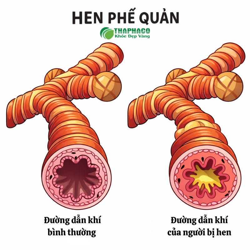 hen phế quản là gì