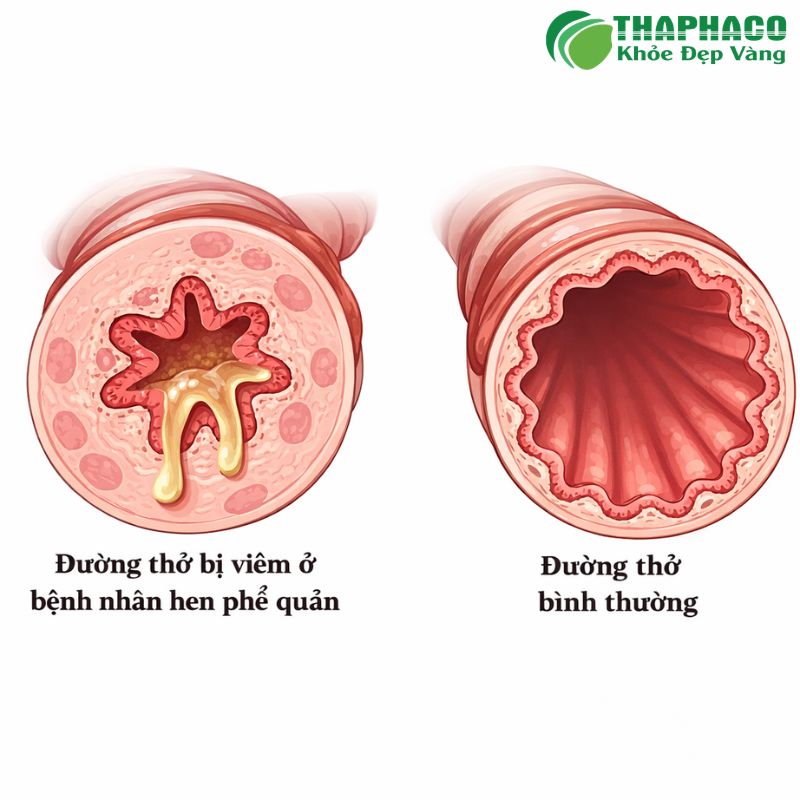 Hen phế quản dị ứng là phản ứng quá mẫn của đường hô hấp với dị nguyên, gây viêm và co thắt