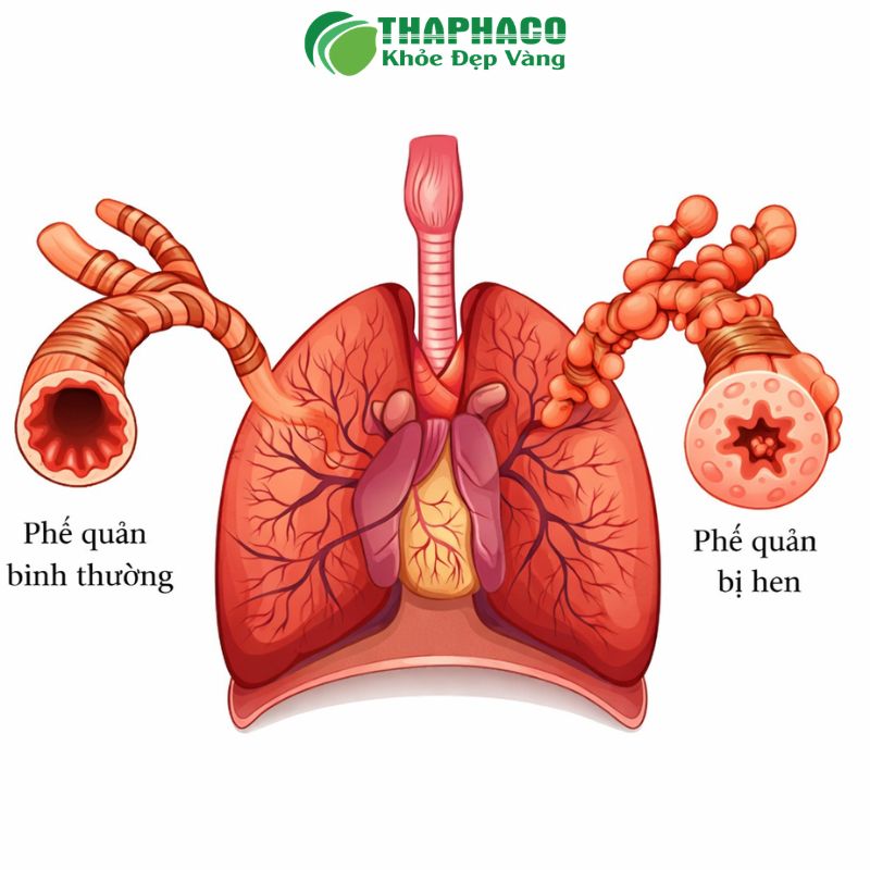 Ho và khó thở là những triệu chứng gây khó chịu nhất của hen phế quản mạn